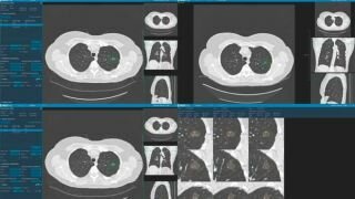 CT Lung Cancer Screening Approved by CMS